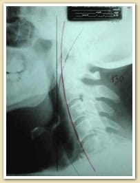 Chiropractic Care Burlington NJ Case Study Chiropractic Care Burlington NJ Case Study
