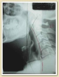 Chiropractic Care Burlington NJ Case Study Chiropractic Care Burlington NJ Case Study