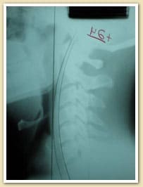 Chiropractic Care Burlington NJ Case Study Chiropractic Care Burlington NJ Case Study