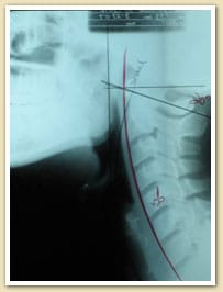 Chiropractic Care Burlington NJ Case Study Chiropractic Care Burlington NJ Case Study