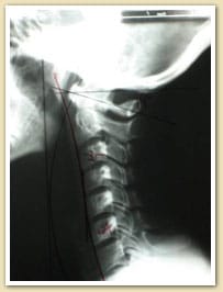 Chiropractic Care Burlington NJ Case Study Chiropractic Care Burlington NJ Case Study