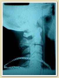 Chiropractic Care Burlington NJ Case Study Chiropractic Care Burlington NJ Case Study