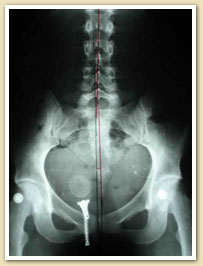 Chiropractic Care Burlington NJ Case Study Chiropractic Care Burlington NJ Case Study